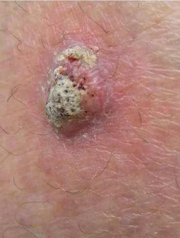 Cell Carcinoma