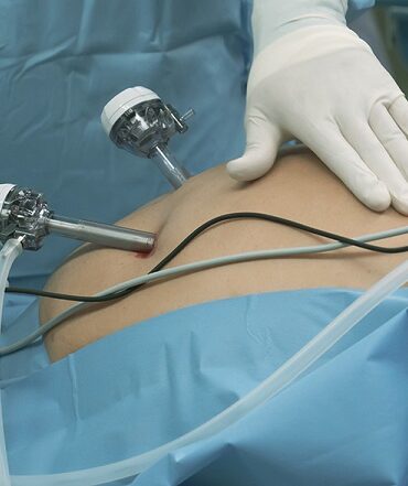 Weight Loss Surgery