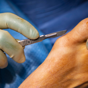 Fat Pad Atrophy Treatment and Its Effect on Standing and Balance